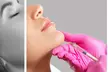 50, 100, or 150 Units of Dysport with Optional One ML Syringe of Restylane (Up to 42% Off) - Second Medium