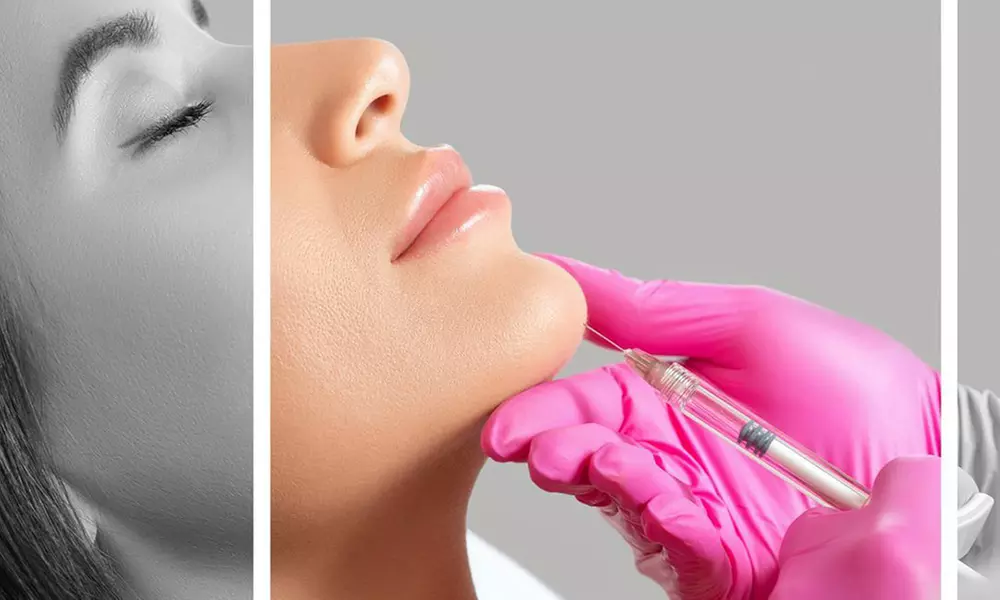 50, 100, or 150 Units of Dysport w/ Optional 1ML Syringe of Restylane