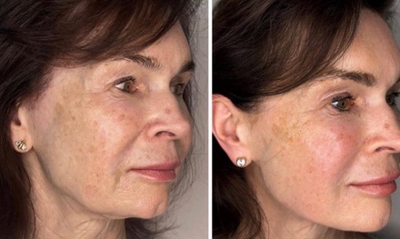 One Session of Polynucleotides or Lemon Bottle Treatment - For Under Eyes - RGN Aesthetics 12