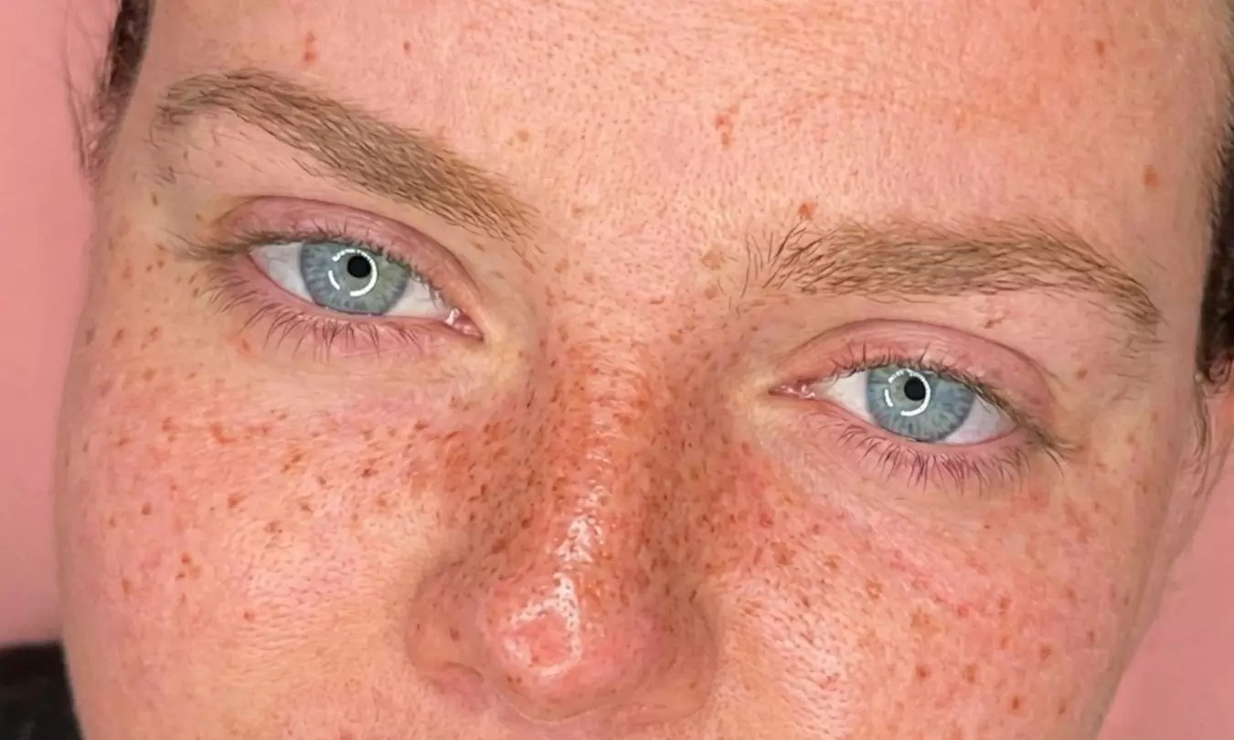 Sesión de micropigmentación de lunares o pecas por tallas XS a XL