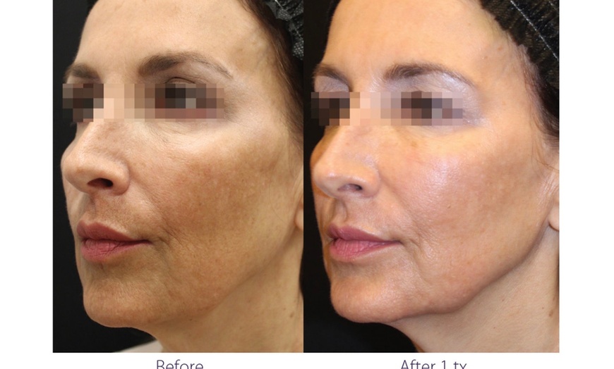 Image 4: ClearLift Laser Session: Face or Face & Neck Rejuvenation
