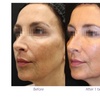 Image 4: ClearLift Laser Session: Face or Face & Neck Rejuvenation