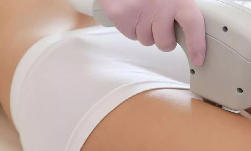 Image 1: 5 séances d’épilation à la lumière pulsée sur une zone au choix