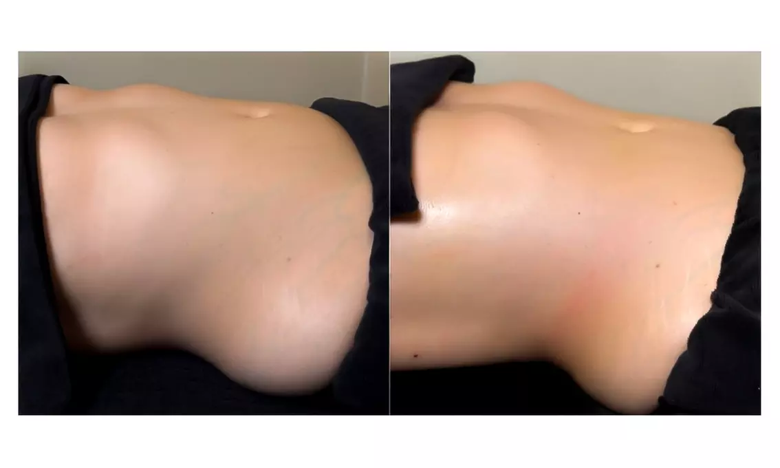 3, 6, 9, or 12 Cavitation, Radiofrequency, and Vacuum Package