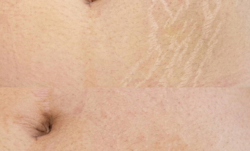 Image 2: Stretch Mark or Scar Treatment - Inkless or Camouflage(Mon-Sat)