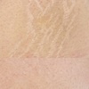 Image 2: Stretch Mark or Scar Treatment - Inkless or Camouflage(Mon-Sat)