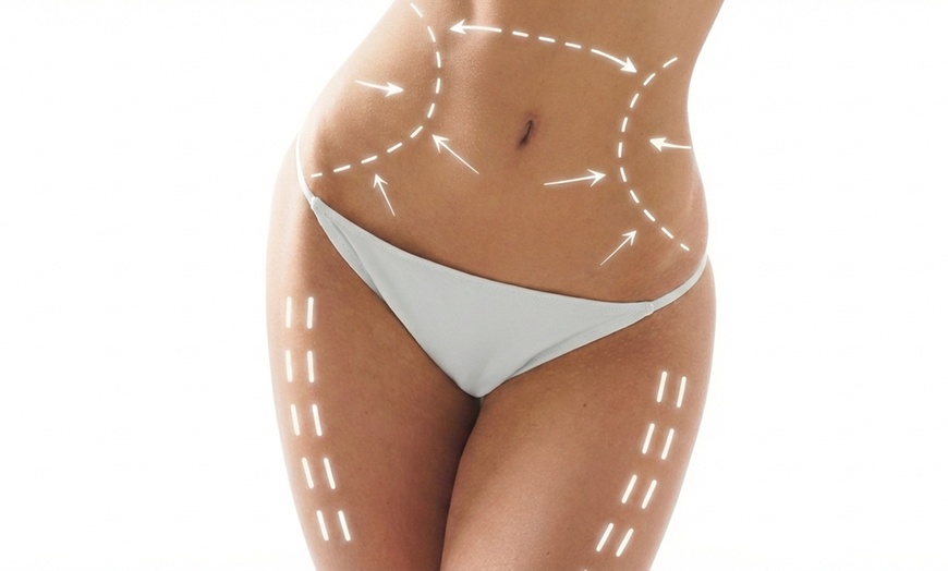 Image 2: Tratamiento corporal con cavitación, presoterapia y opción a lipoláser