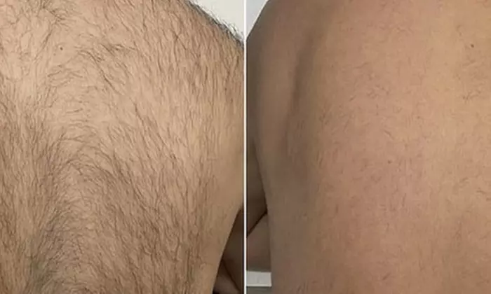 Laser Hair Removal Session - Brazilian, Underarms, Full Leg, or Back