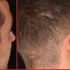 Image 3: Boost Your Glow with Natural PRF Treatments