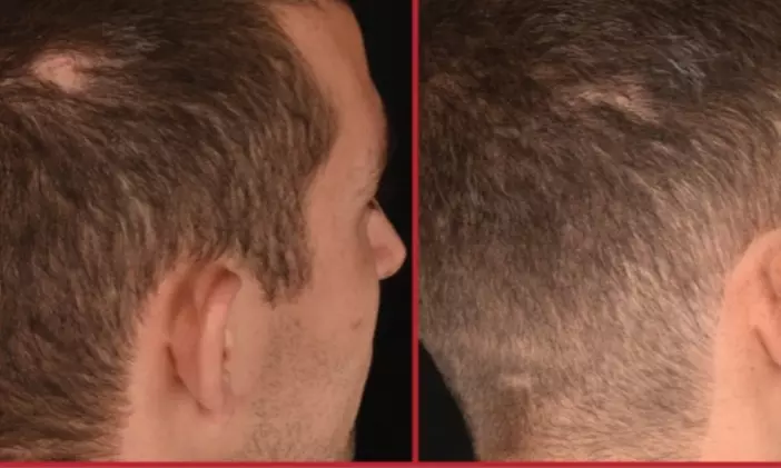 Glow Effortlessly at Northshore Health and Beauty Using PRF Treatments for Various Facial Zones, up to 35% Off - Second Medium