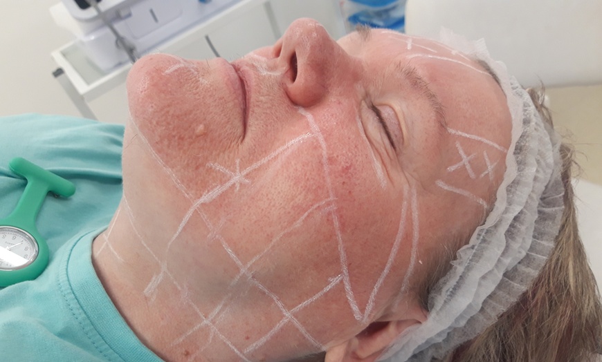 Image 3: Lift and Tone with Advanced HIFU for Face With or Without Neck