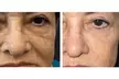 Glow Up with CO₂ Full Ablative Skin Resurfacing Or Low-Pain Fractional CO₂ (Up to 45% Off) - Second Medium