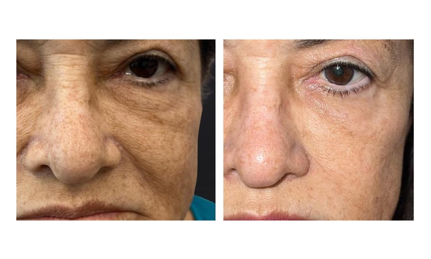 Image 2: CO₂ Full Ablative Skin Resurfacing Or Low-Pain Fractional CO₂