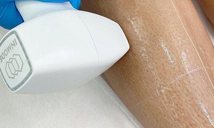 Three Laser Hair Removal Sessions on One Small Area - Skinovatio Medical Spa South Loop