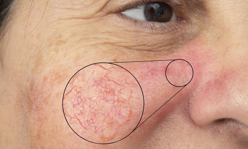 Image 1: Laser Thread Vein Removal Treatment – Say Goodbye to Unwanted Veins
