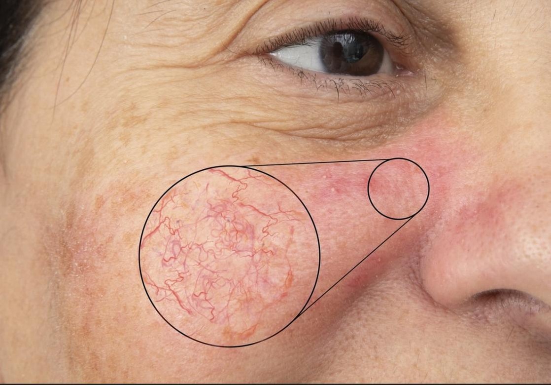 Laser Thread Vein Removal Treatment – Say Goodbye to Unwanted Veins