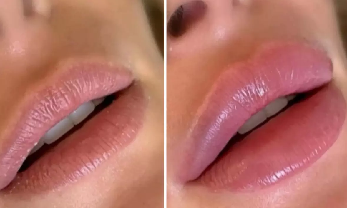 Boost Your Confidence with Hydrated, Defined Lips - 30% Off  at V Glow Miami - Second Medium