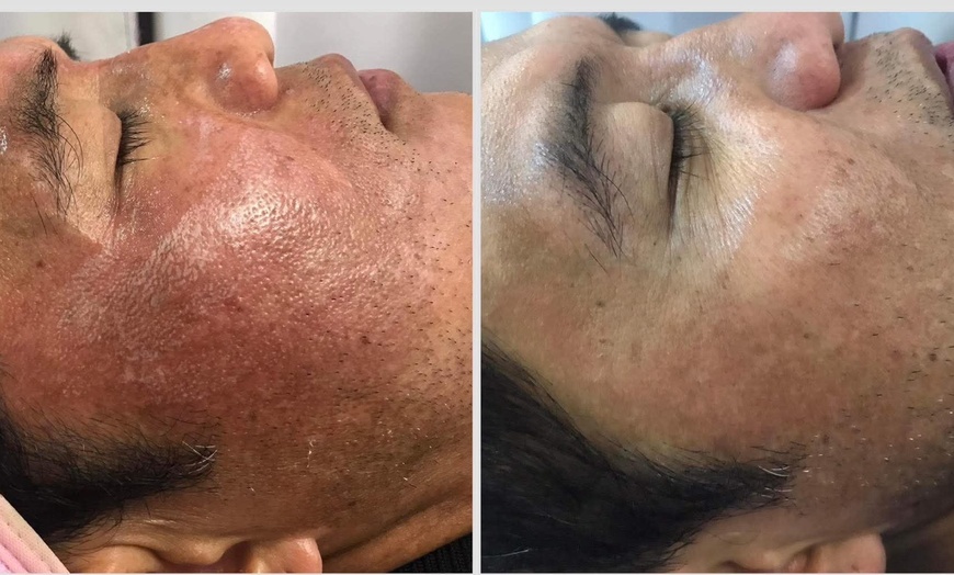 Image 8: One, Two or Three 60-Minute Signature Facials with Chemical Peels