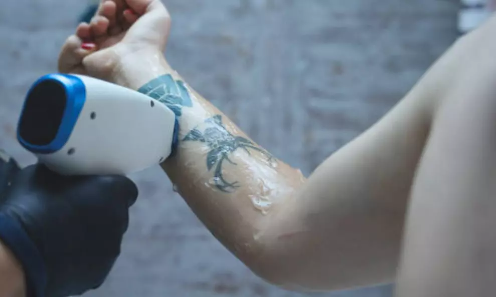 3 o 6 sesiones de eliminación de tatuajes o micropigmentación con hasta un 70% de descuento - Primary Image