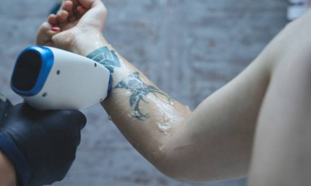 3 sesiones de eliminación de tatuajes o micropigmentación de hasta 5x5 cm - Elavie Centro Medico Estetico