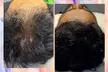 Up to 58% Off PRP Hair Treatment at Permanent Aesthetics Studio - Second Medium