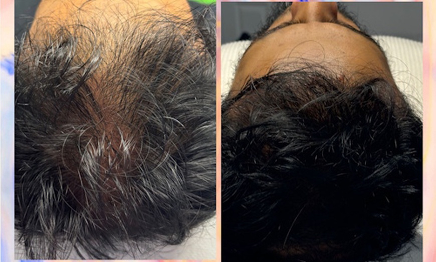 Image 2: Up to 58%  Off PRP Hair Treatment 