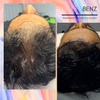 Image 2: Up to 58%  Off PRP Hair Treatment 