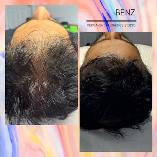 Up to 58%  Off PRP Hair Treatment