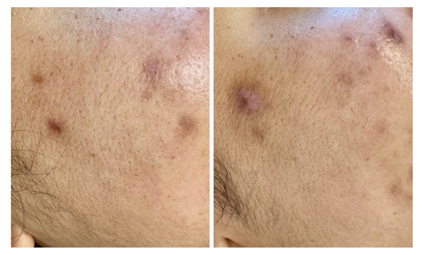 Image 2: Micro-needling with LED Light Therapy to Improve Skin Texture