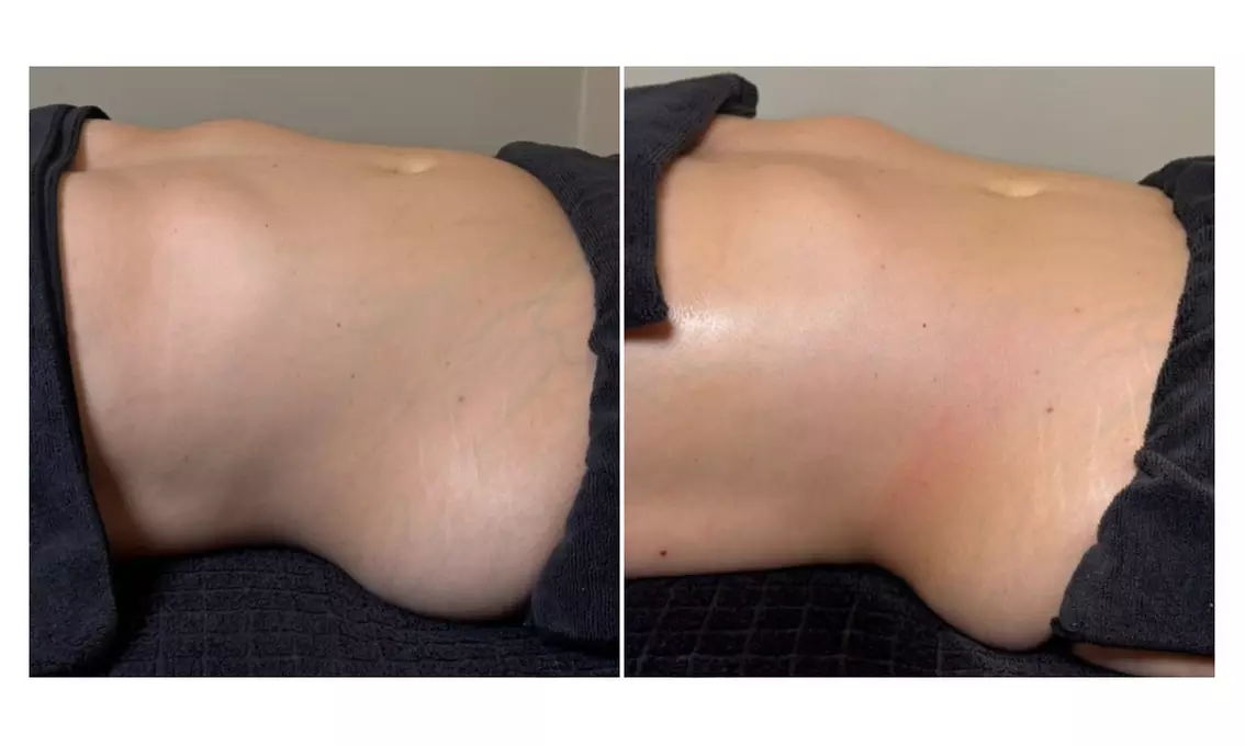 Three, Six, Nine, or Twelve Snella Non-Invasive Laser Lipo Sessions