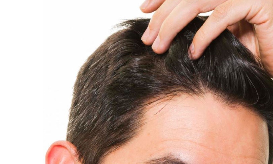 Image 1: Bioestimulación en cuero cabelludo para la regeneración capilar