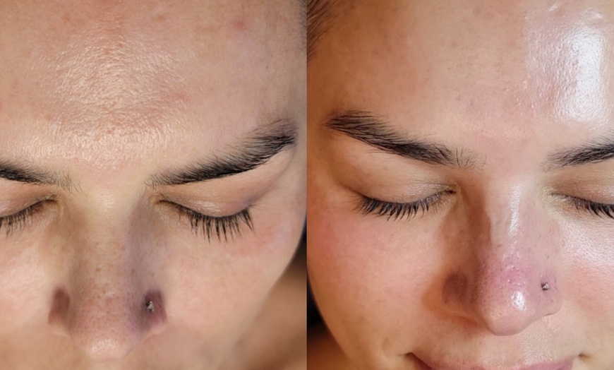 Image 2: Up to 60% Off Facials with Dermaplaning at Vibrance Med Spa