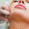 Image 1: Target and Reduce Double Chin Fat with Kybella at Medspa California
