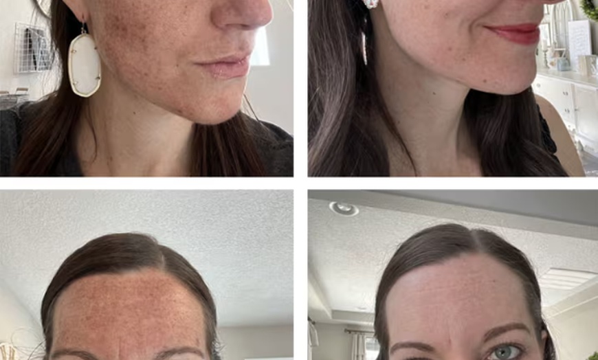 Image 6: 60-Min Facial & Platinum Skincare Chemical Peel for Skin Rejuvenation