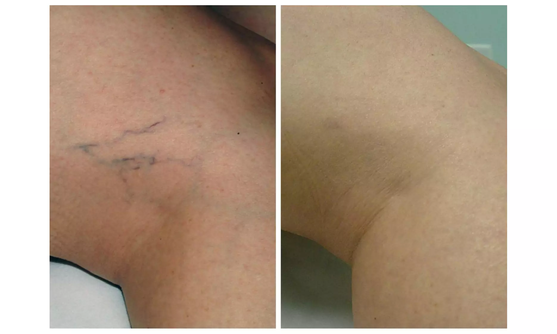 Effective One or Two Spider Vein Removal Laser Treatment 2 Inch x 2 Inch Area @Aquavita Wellness (Up to 60%Off) - Second Medium