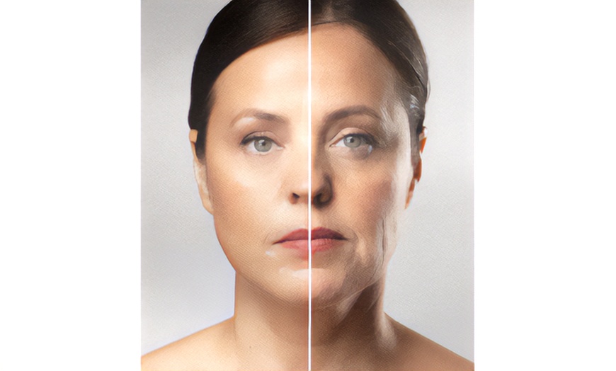Image 2: One Microneedling Treatment with PRND, HA or Exosomes for Full Face