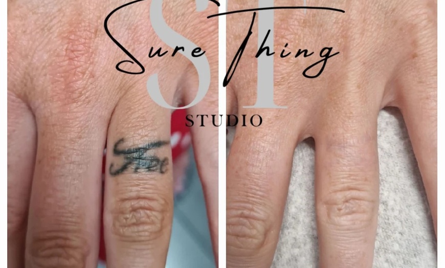 Image 2: Up to 86% Off on Tattoo Removal at Sure Thing Studio