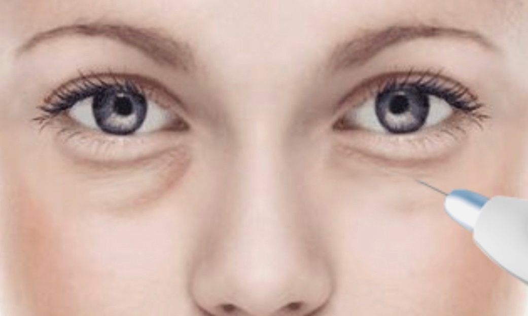 Fibroblast Plasma Pen for Upper Eyelids, Under Eyes, or Full Eye Area