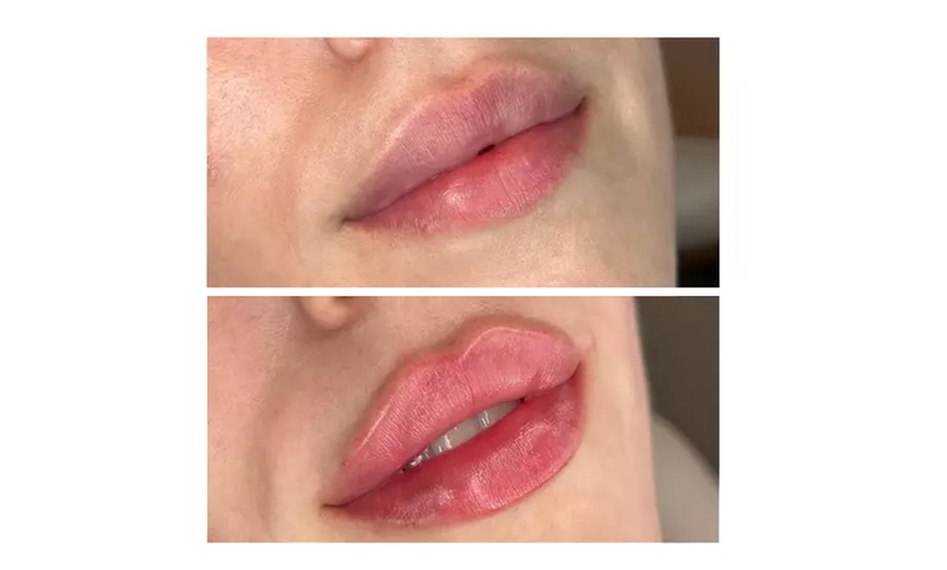 Image 3: Enhance Your Beauty with 1ml or 2ml Dermal Filler