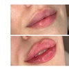 Image 3: Enhance Your Beauty with 1ml or 2ml Dermal Filler