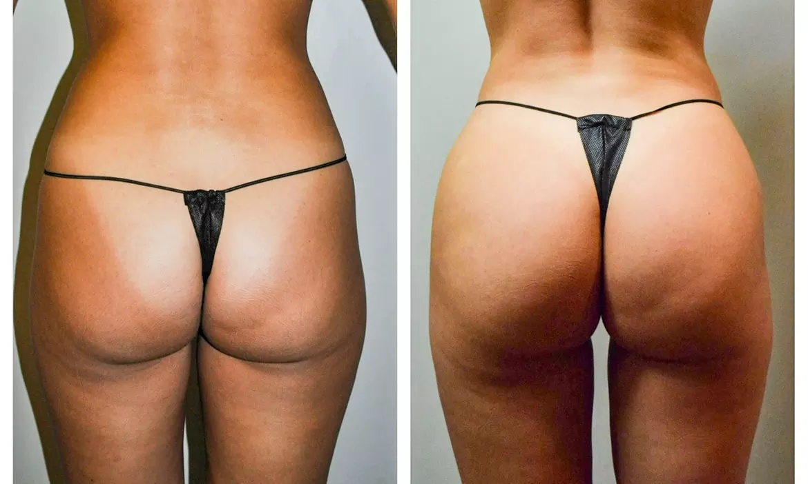 Enhance with Half or One Full Vial of Sculptra for the Buttocks