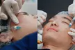 Revitalize with 1, 2, or 3 Full Face & Neck Profound RF Microneedling with 1ml Rejuran Healer (Up to 79%Off) - Second Medium