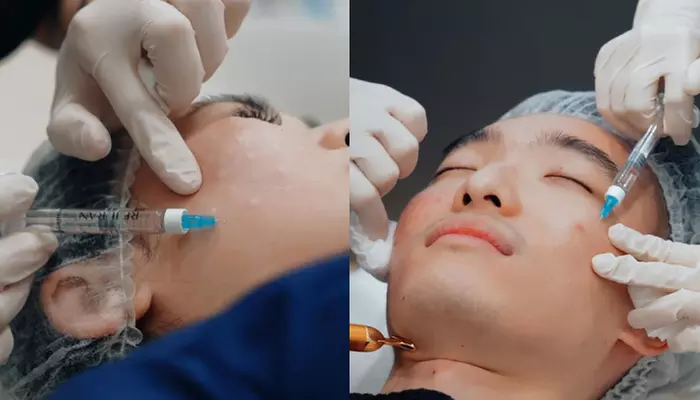 1, 2, or 3 Full Face & Neck Profound RF Microneedling + Rejuran Healer