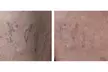 1 or 2 Spider Vein/Cluster Removal Treatment with Consultation/ Dark Spot Treatment Small Area (Up to 45% Off) - Second Medium