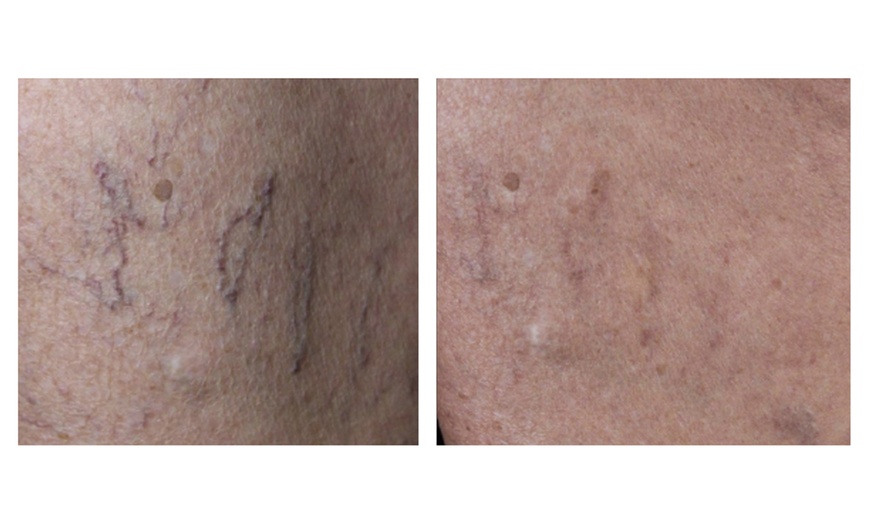 Image 5: One or Two Spider Vein/Cluster Removal Treatment with Consultation