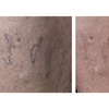 Image 4: One or Two Spider Vein/Cluster Removal Treatment with Consultation