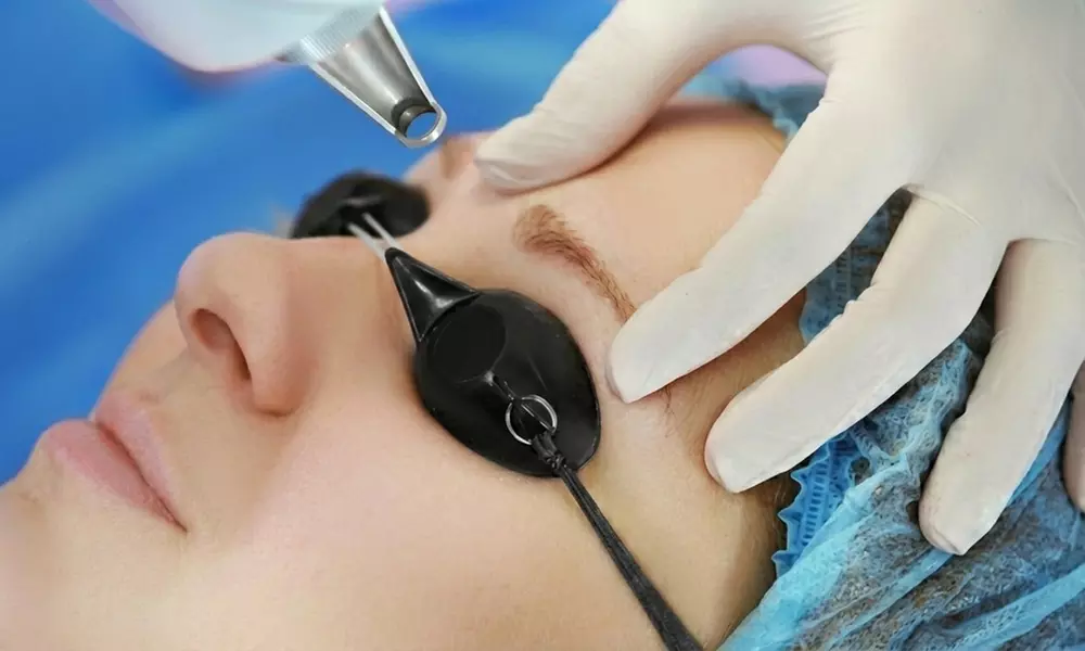 One or Two Sessions: Eyebrow Tattoo PicoLaser Removal