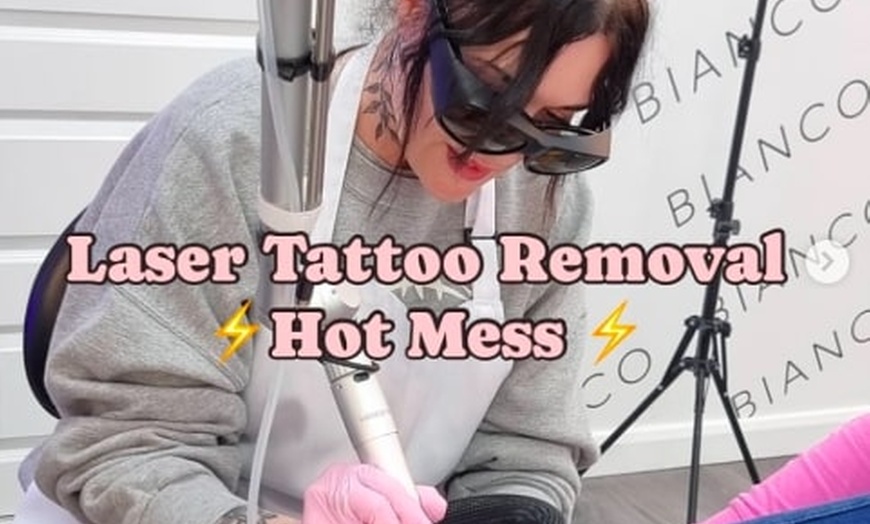 Image 2: Up to 60% Off on Tattoo Removal at Hot Mess