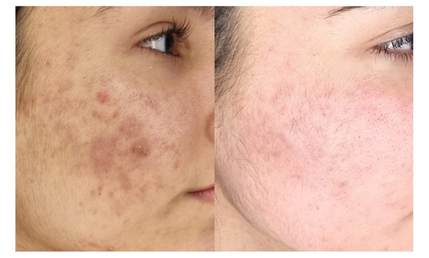 Image 4: Microneedling für Gesicht, opt. inkl. Hals oder SQT BiONeedling