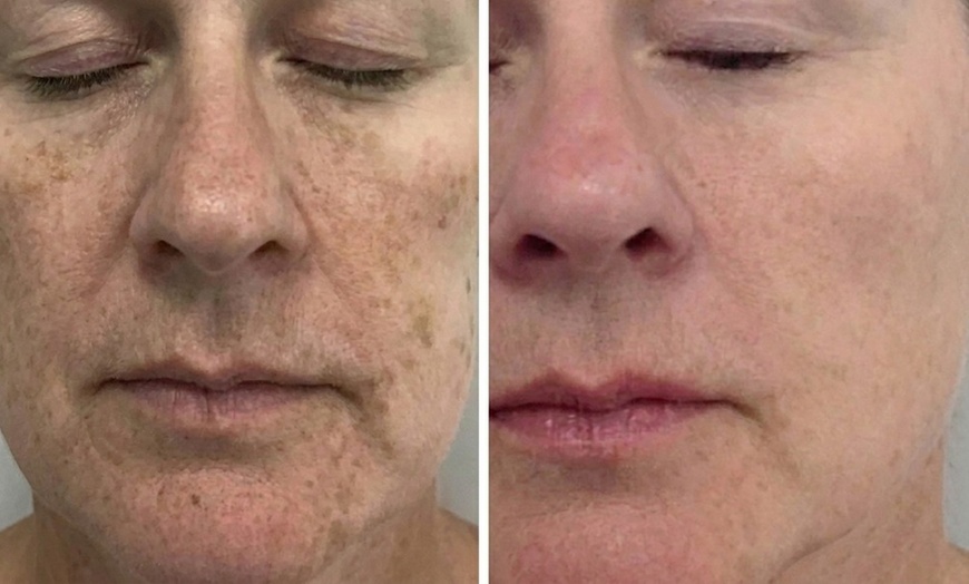 Image 2: Custom Glow Facial Package or BioRePeel - Next Generation Peel